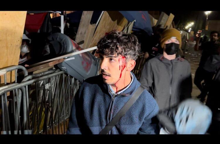 An injured protestor allegedly struck by a metal pipe or baton is escorted to safety by other protestors during a night of violence between pro-Israel and pro-Palestine protestors at UCLA on April 30, 2024. Anthony Cabassa